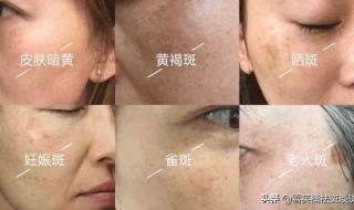 最有效祛斑 最有效祛斑